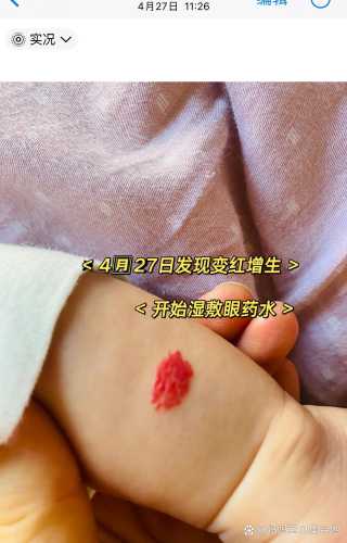 新生儿面部血管瘤怎么办-第1张图片