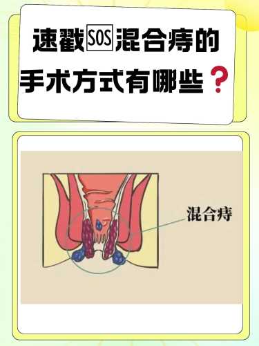 有外痔疮可以顺产吗-第1张图片