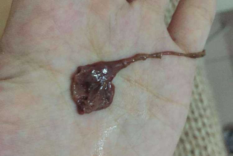 药物流产后感染症状有哪些-第1张图片