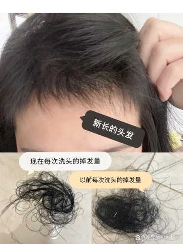 产后掉东西是怎么回事-第1张图片