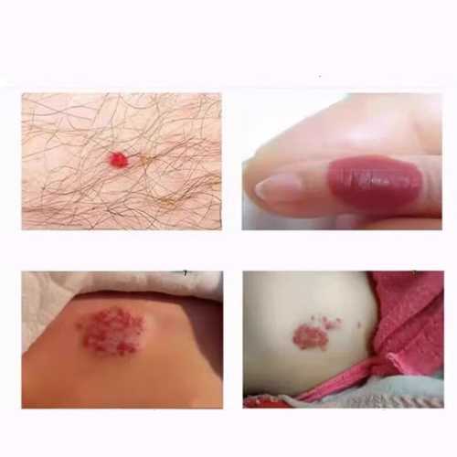 新生儿红色血管瘤有何危害-第1张图片