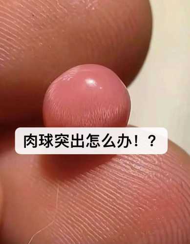 二胎产后有痔疮该怎么办-第1张图片