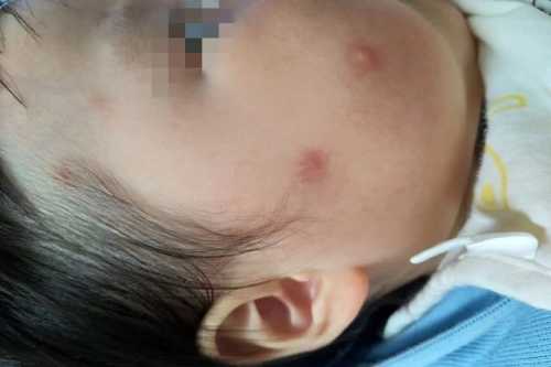 婴儿丘疹图片啥样有何特征-第1张图片