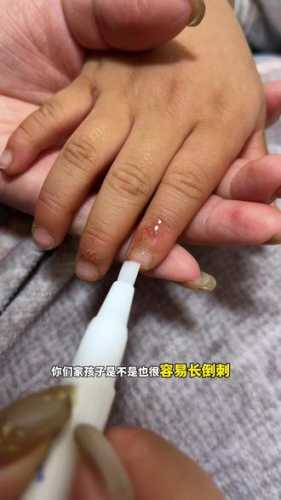 婴儿手指长倒刺怎么办-第1张图片