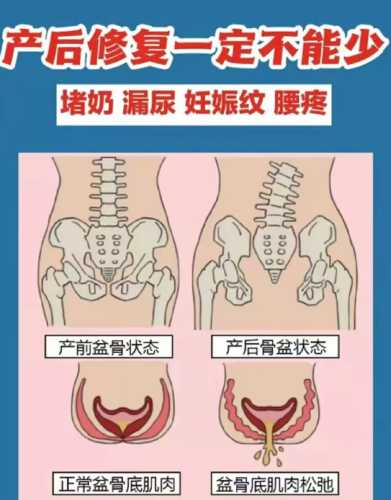 产后如何评估盆底肌力-第1张图片