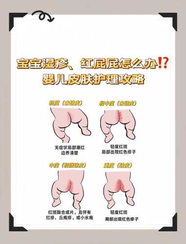婴儿湿疹怎么弄才能好起来-第1张图片