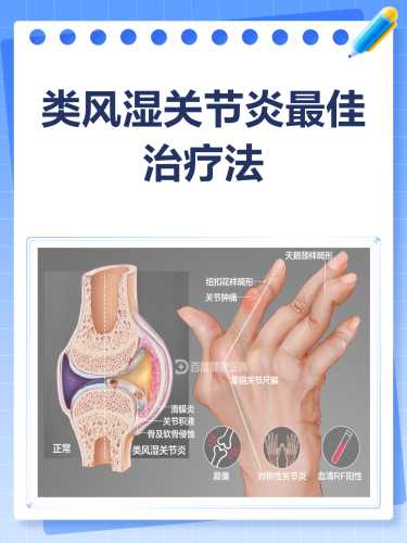 月子风湿病怎么治疗才有效-第1张图片