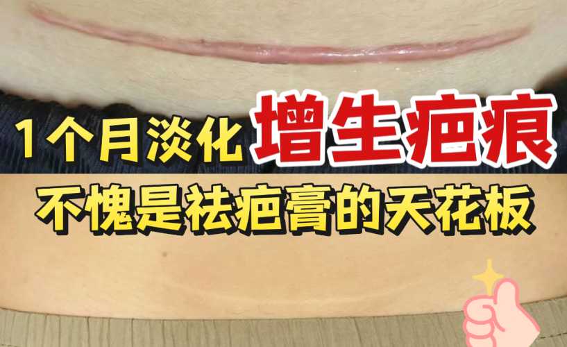 剖腹产疤痕增生期时长是多久-第1张图片