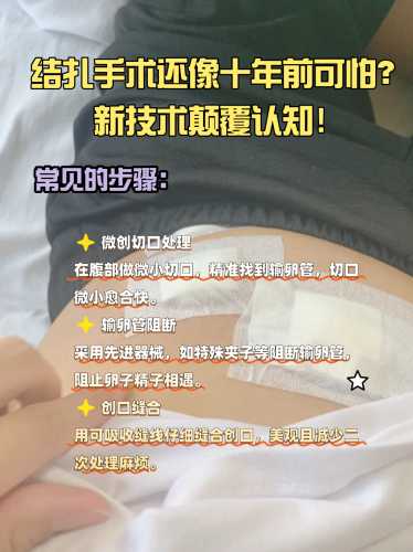 女人剖腹产同时结扎好吗-第1张图片
