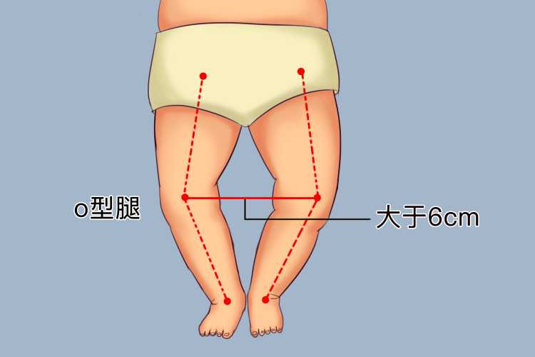 纸尿裤会导致宝宝0型腿吗-第1张图片