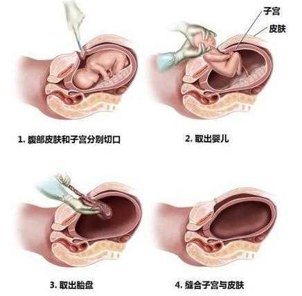 剖腹产露肚子开刀是怎样的-第1张图片