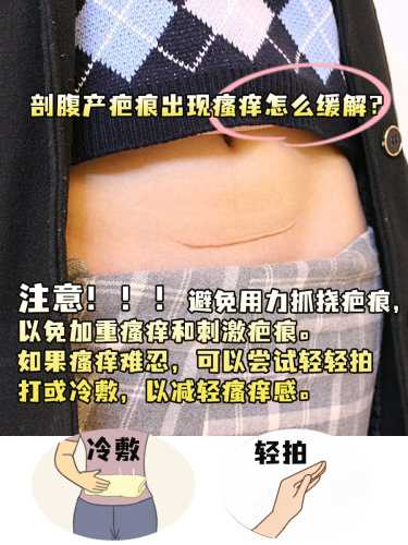 剖腹产一年后伤疤图片什么样-第1张图片