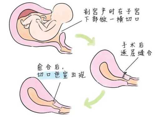 剖宫产后为什么要吸氧-第1张图片