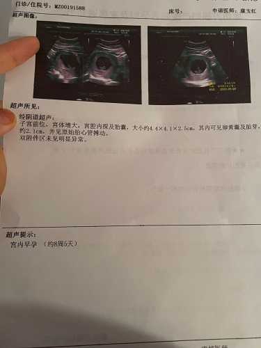 六周多孕反严重正常吗-第1张图片