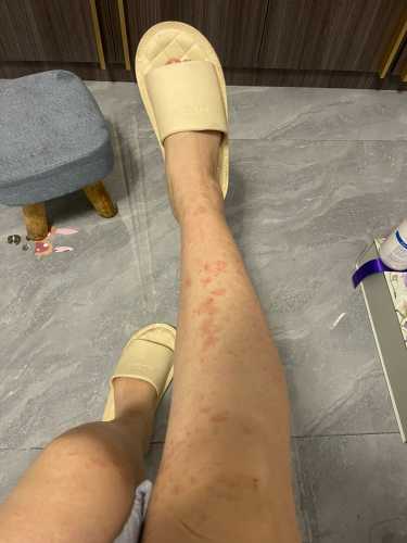 产后下面痒怎么回事-第1张图片