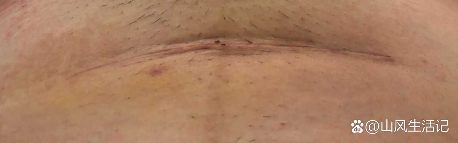 剖腹产刀口出现脂肪液怎么办-第1张图片
