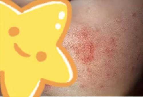 尿不湿过敏什么样-第1张图片