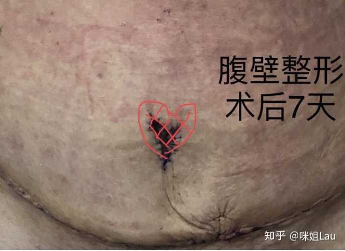 剖腹产刀口上方有赘肉咋办-第1张图片