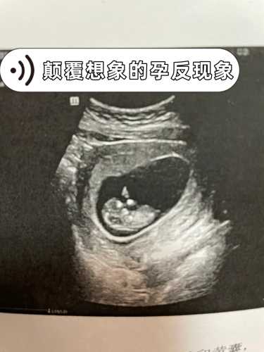 轻度孕反是怀男孩的征兆吗-第1张图片
