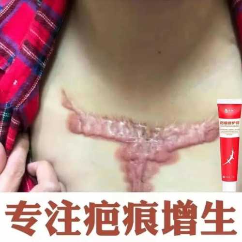 剖腹产小疙瘩如何消除-第1张图片