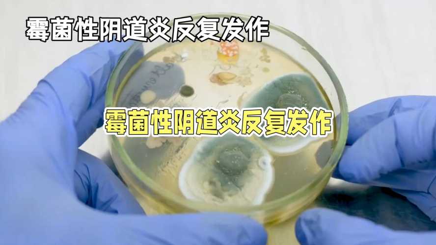 备孕女性霉菌危害大不大-第1张图片