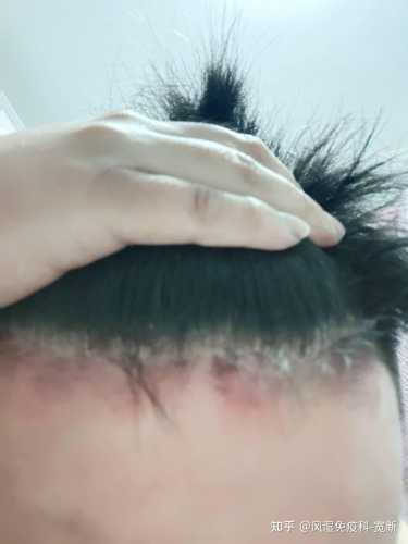 月子风湿病有啥症状-第1张图片