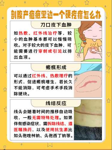 剖腹产如何取出宝宝-第1张图片