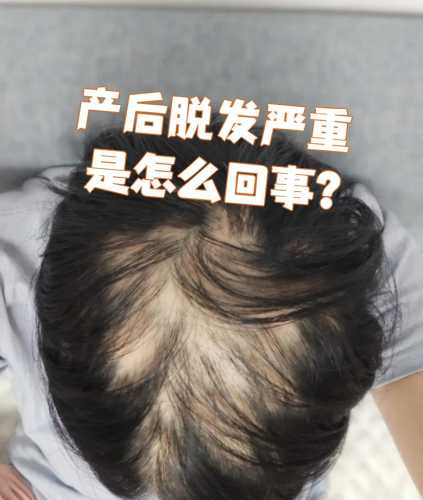 产后为啥会脱发-第1张图片