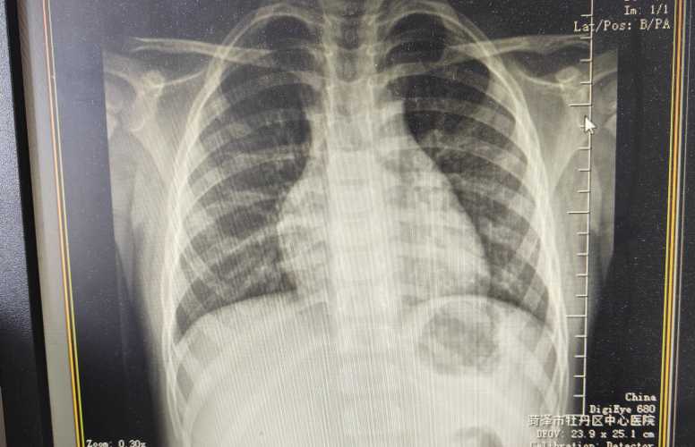 婴儿肺炎会发烧吗-第1张图片