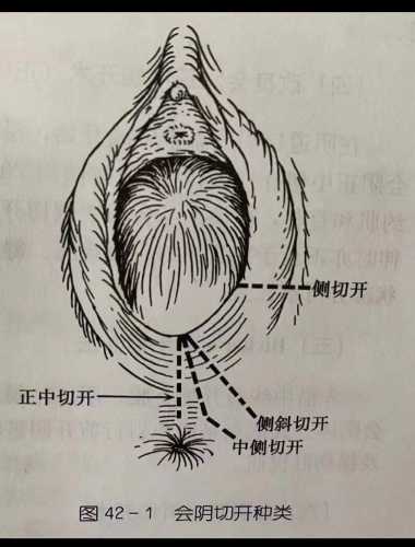 顺产侧切伤口裂开有图片吗-第1张图片
