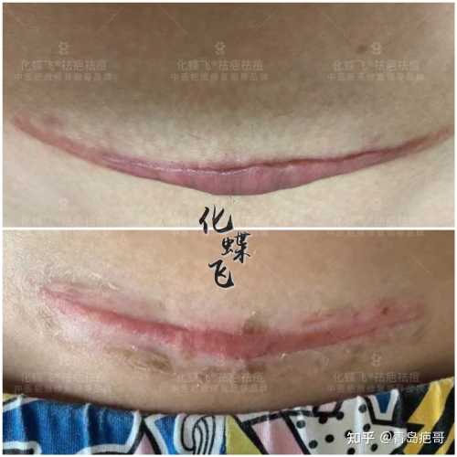剖腹产疤痕对孩子有影响吗-第1张图片