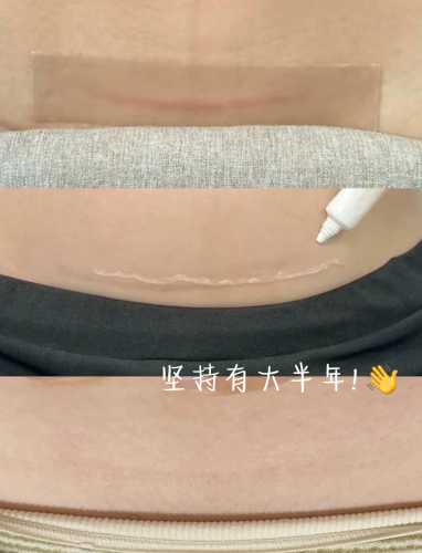 剖腹产术后没有尿意怎么办-第1张图片