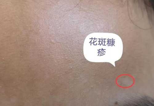 新生儿脸上有白斑怎么办-第1张图片