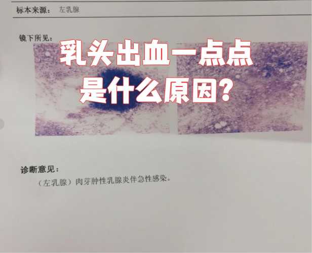 流产后乳头溢水正常吗-第1张图片