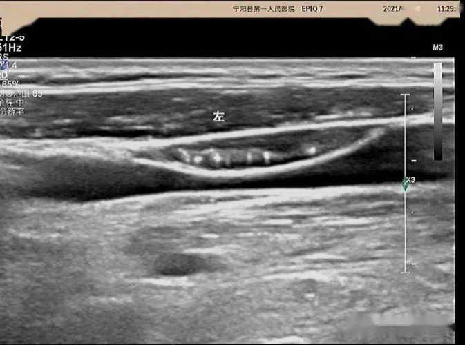 甲状腺b超对备孕有影响吗-第1张图片