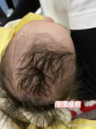 婴儿头皮青怎么回事-第1张图片