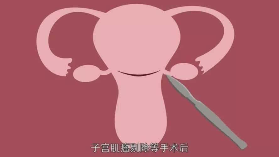 剖腹产清宫原因是什么-第1张图片
