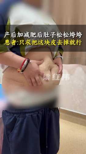 产后肚子松弛是什么样的图片-第1张图片