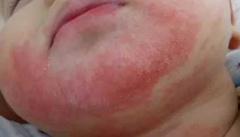 焦婴儿的原因是什么-第1张图片