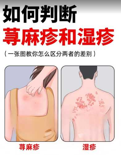 剖腹产与湿疹有什么关系吗-第1张图片