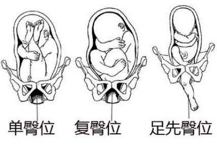 臀位剖腹产最佳时间是什么时候-第1张图片