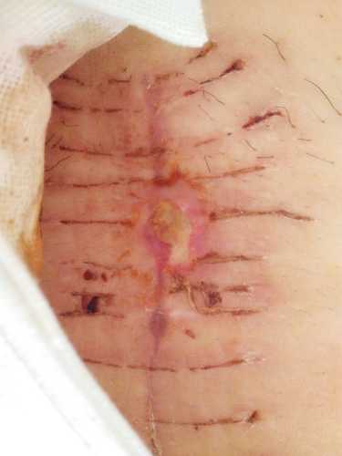 剖腹产孩子腹围有啥影响吗-第1张图片