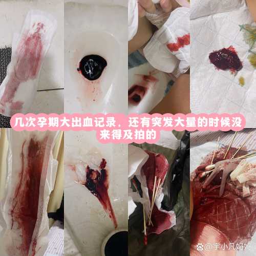 完全性前置胎盘剖腹产风险大吗-第1张图片