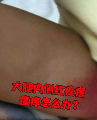 产后大腿内侧长疙瘩咋回事-第1张图片