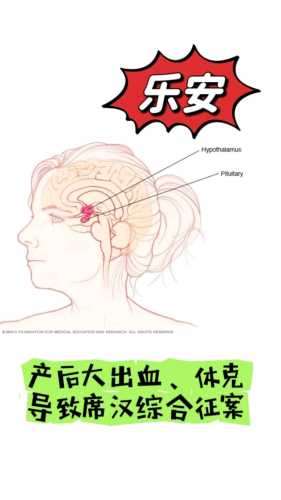产后大出血原因是什么-第1张图片
