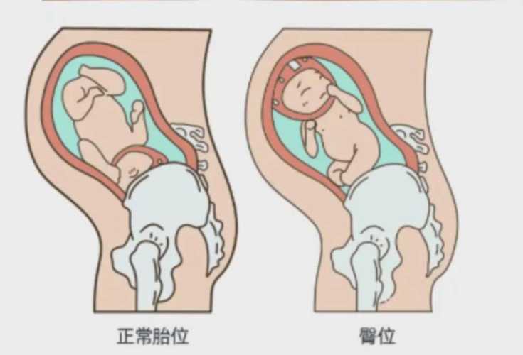 横位剖腹产有何危险-第1张图片
