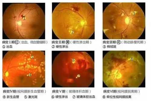流产后眼睛模糊怎么办-第1张图片