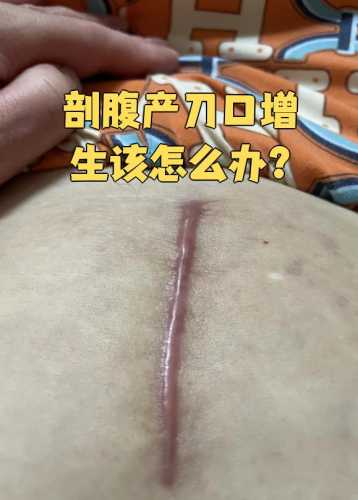 剖腹产后有囊肿该怎么办-第1张图片