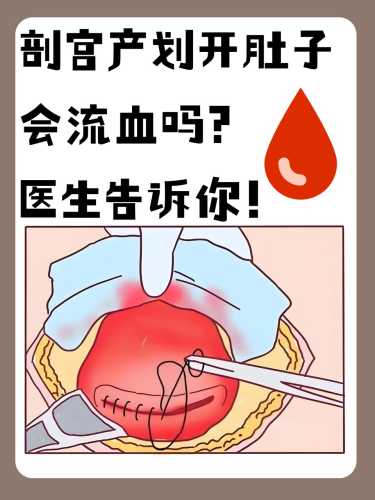 顺产剖腹产哪个更痛-第1张图片