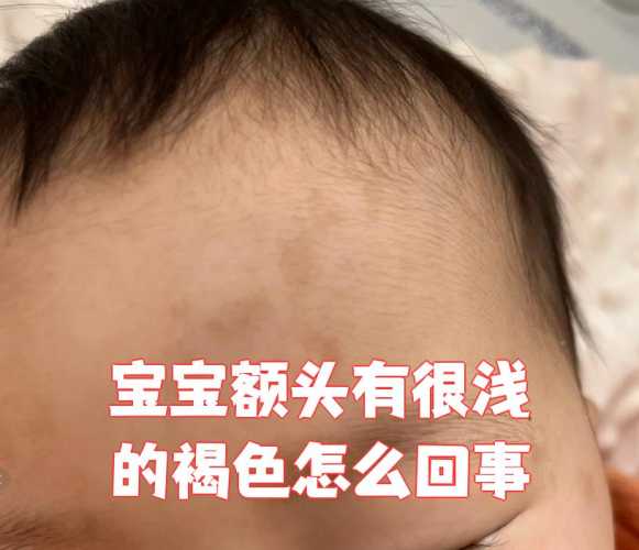 婴儿额头平是怎么回事-第1张图片